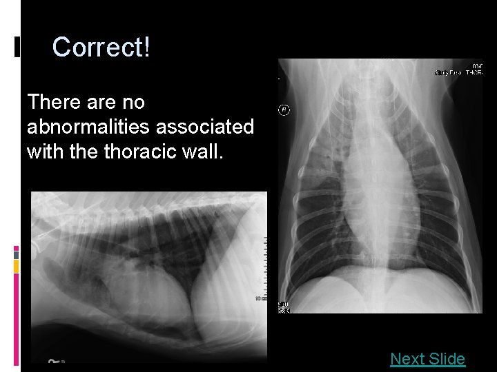 Correct! There are no abnormalities associated with the thoracic wall. Next Slide 