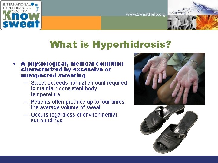 What is Hyperhidrosis? • A physiological, medical condition characterized by excessive or unexpected sweating