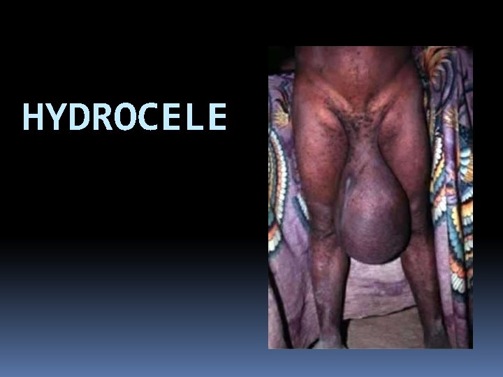 HYDROCELE 