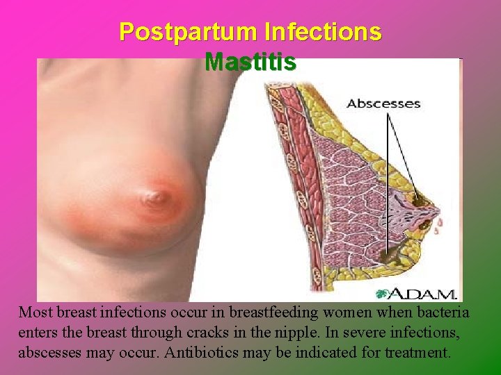 Postpartum Infections Mastitis Most breast infections occur in breastfeeding women when bacteria enters the