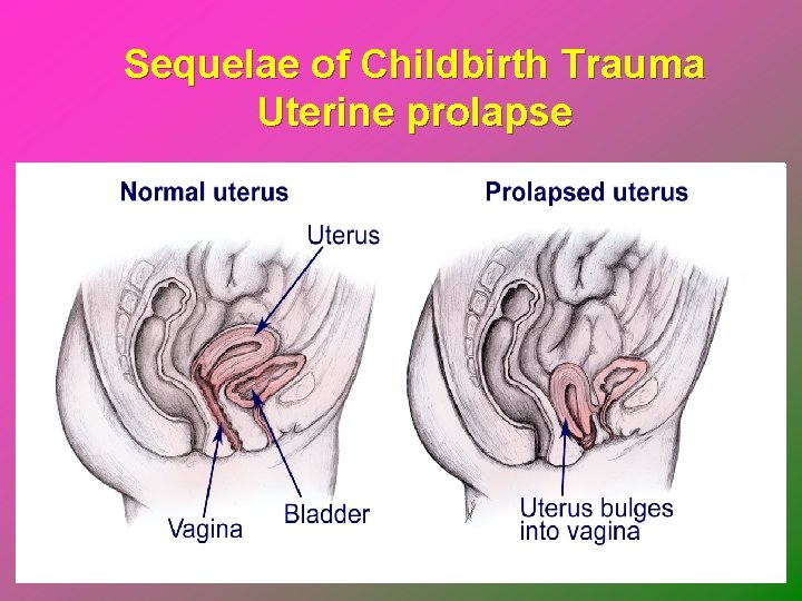 Sequelae of Childbirth Trauma Uterine prolapse 