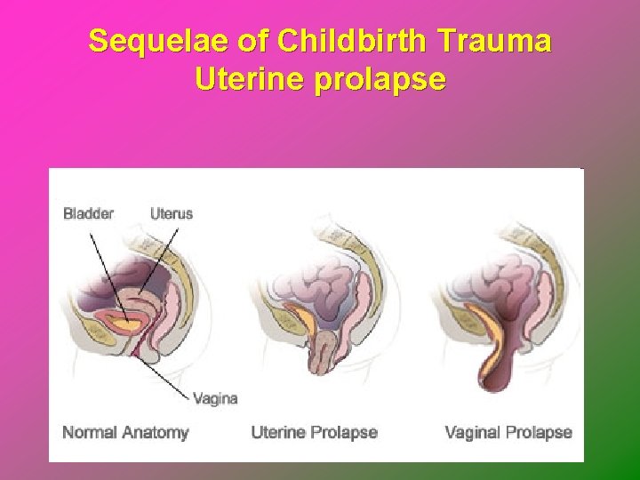 Sequelae of Childbirth Trauma Uterine prolapse 