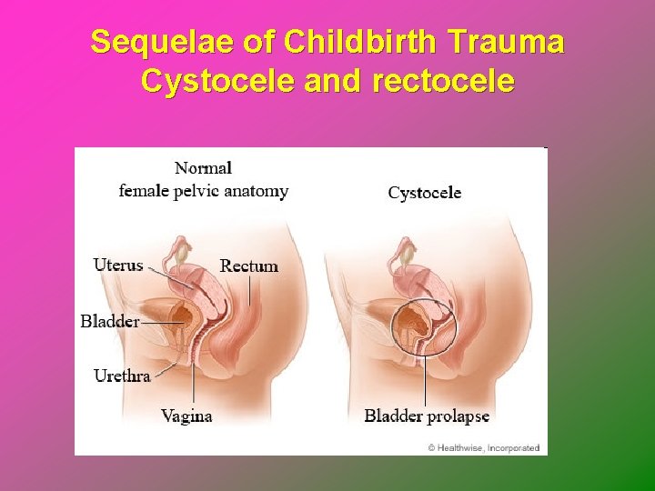 Sequelae of Childbirth Trauma Cystocele and rectocele 