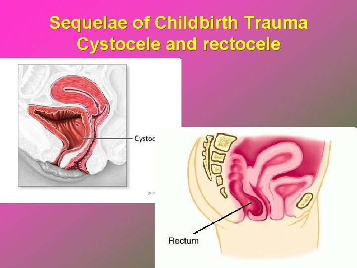 Sequelae of Childbirth Trauma Cystocele and rectocele 