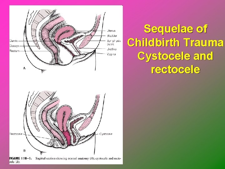 Sequelae of Childbirth Trauma Cystocele and rectocele 