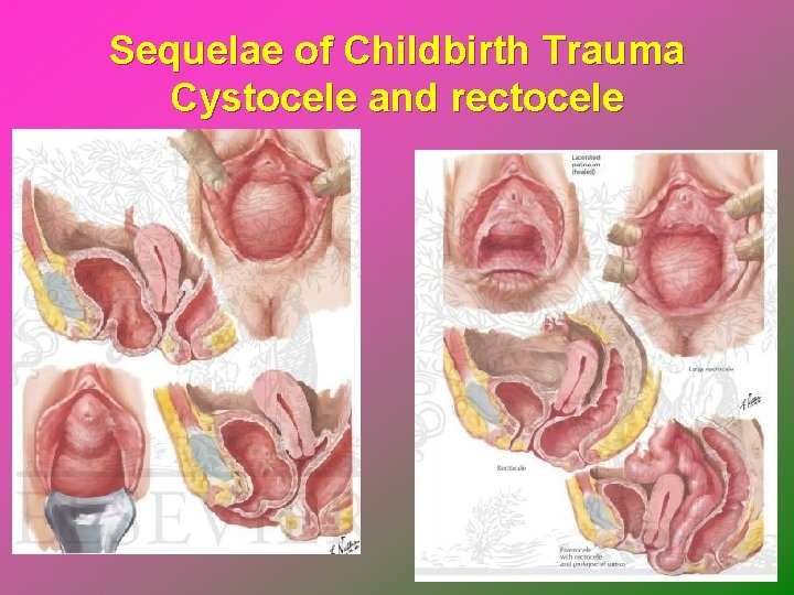 Sequelae of Childbirth Trauma Cystocele and rectocele 