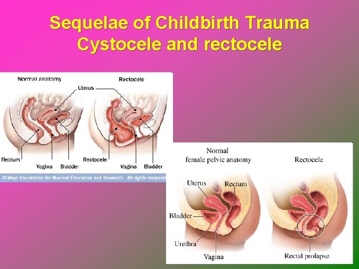 Sequelae of Childbirth Trauma Cystocele and rectocele 