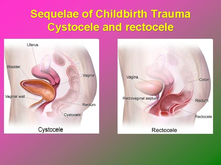 Sequelae of Childbirth Trauma Cystocele and rectocele 