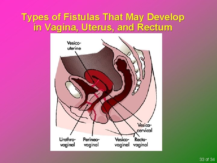 Types of Fistulas That May Develop in Vagina, Uterus, and Rectum 33 of 34
