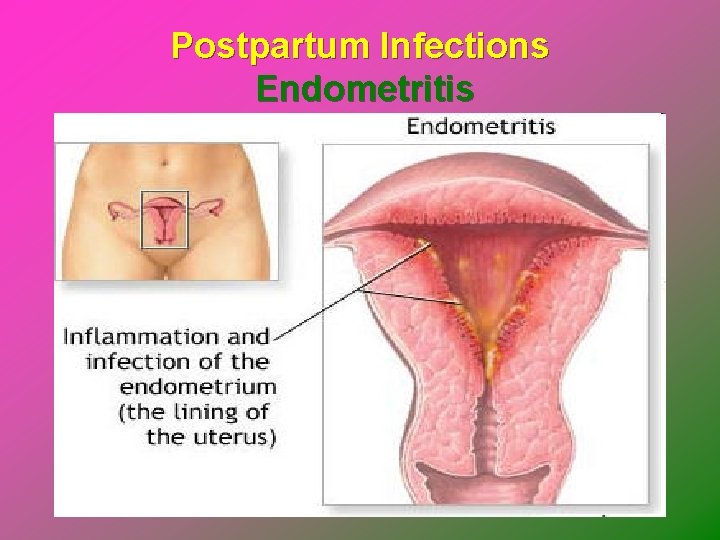Postpartum Infections Endometritis 