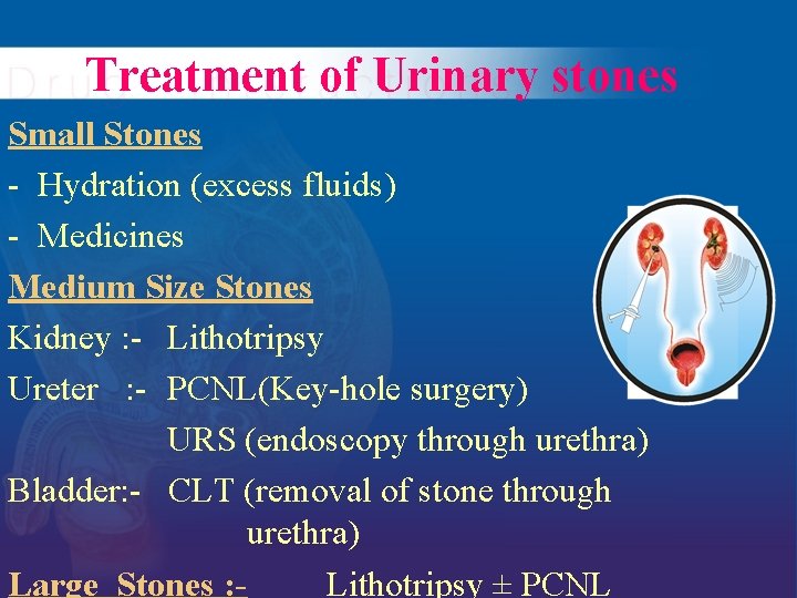 Treatment of Urinary stones Small Stones - Hydration (excess fluids) - Medicines Medium Size