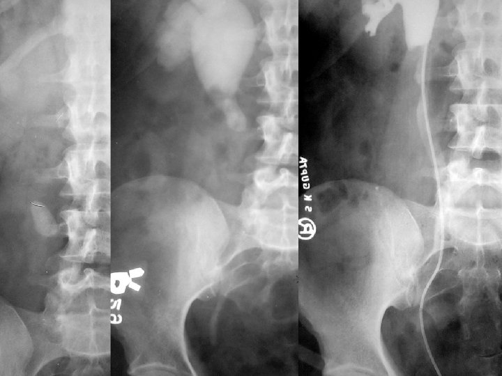 Therapeutic Options Upper Ureteric calculus Small Large (<15 X 10 mm) Dur. Small long