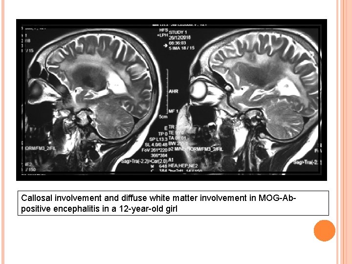 Callosal involvement and diffuse white matter involvement in MOG-Abpositive encephalitis in a 12 -year-old