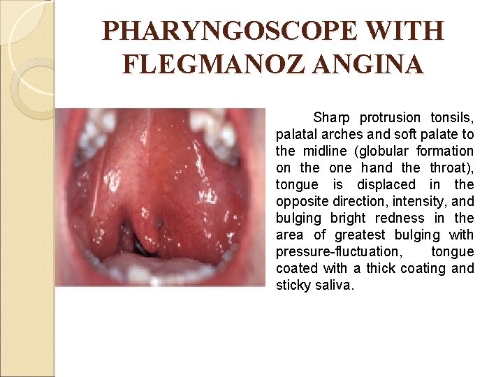 PHARYNGOSCOPE WITH FLEGMANOZ ANGINA Sharp protrusion tonsils, palatal arches and soft palate to the