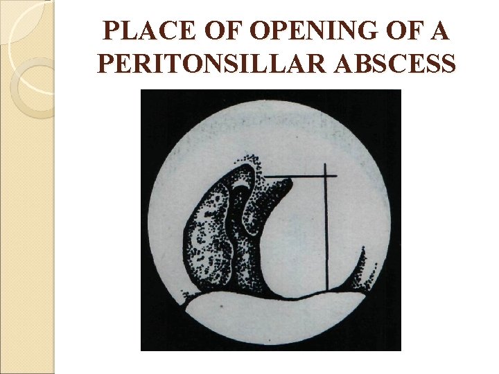 PLACE OF OPENING OF A PERITONSILLAR ABSCESS 