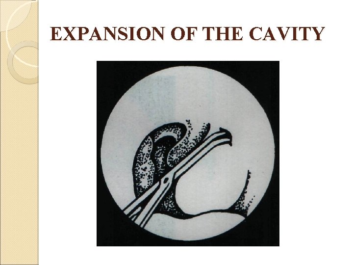 EXPANSION OF THE CAVITY 