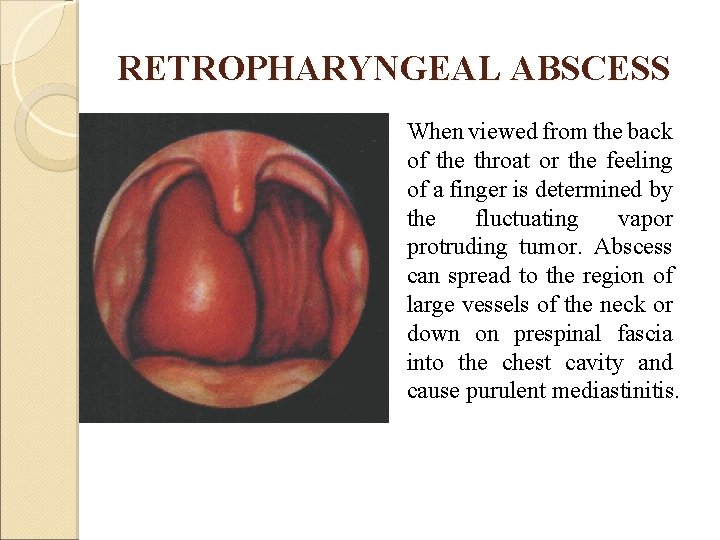 RETROPHARYNGEAL ABSCESS When viewed from the back of the throat or the feeling of