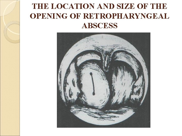 THE LOCATION AND SIZE OF THE OPENING OF RETROPHARYNGEAL ABSCESS 