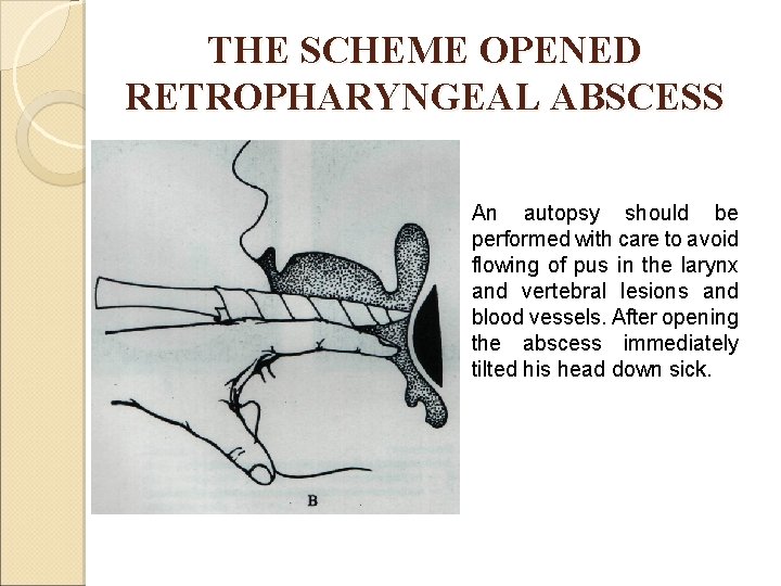 THE SCHEME OPENED RETROPHARYNGEAL ABSCESS An autopsy should be performed with care to avoid