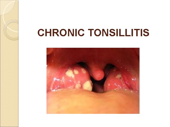 CHRONIC TONSILLITIS 