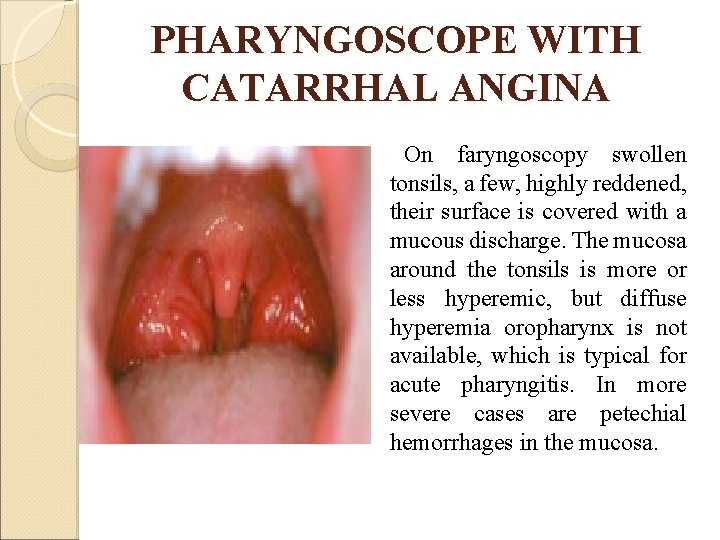 PHARYNGOSCOPE WITH CATARRHAL ANGINA On faryngoscopy swollen tonsils, a few, highly reddened, their surface