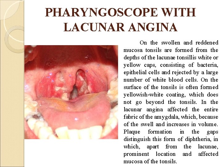 PHARYNGOSCOPE WITH LACUNAR ANGINA On the swollen and reddened mucosa tonsils are formed from