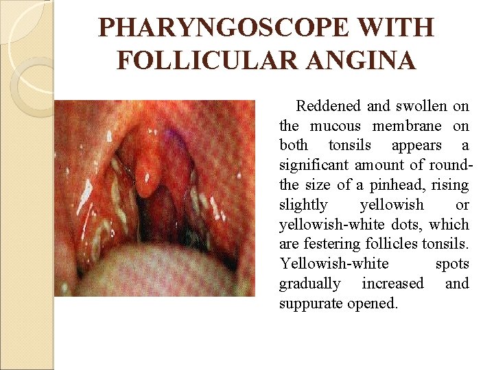 PHARYNGOSCOPE WITH FOLLICULAR ANGINA Reddened and swollen on the mucous membrane on both tonsils