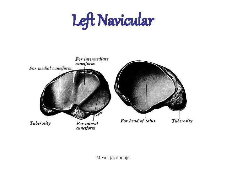 Left Navicular Mehdi jalali majd 