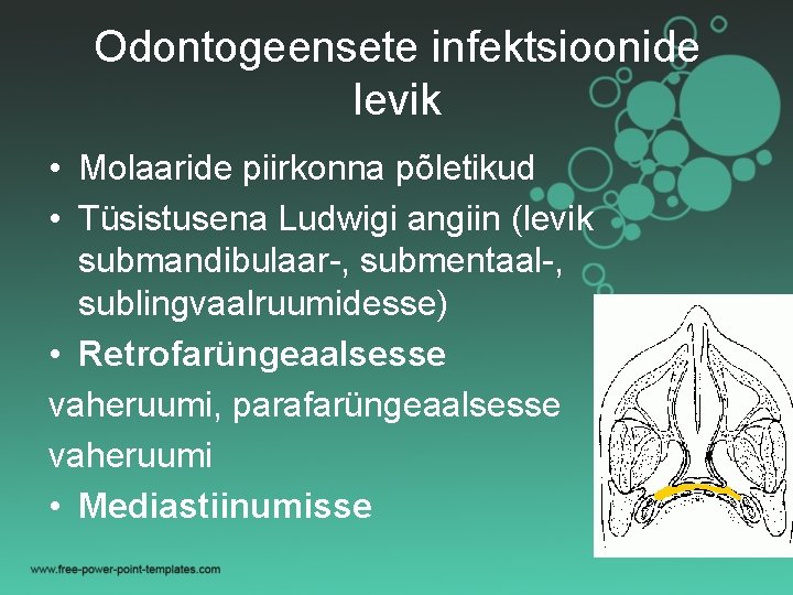 Odontogeensete infektsioonide levik • Molaaride piirkonna põletikud • Tüsistusena Ludwigi angiin (levik submandibulaar-, submentaal-,