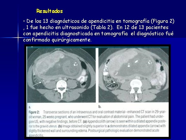 Resultados • De los 13 diagnósticos de apendicitis en tomografía (Figura 2) , 1