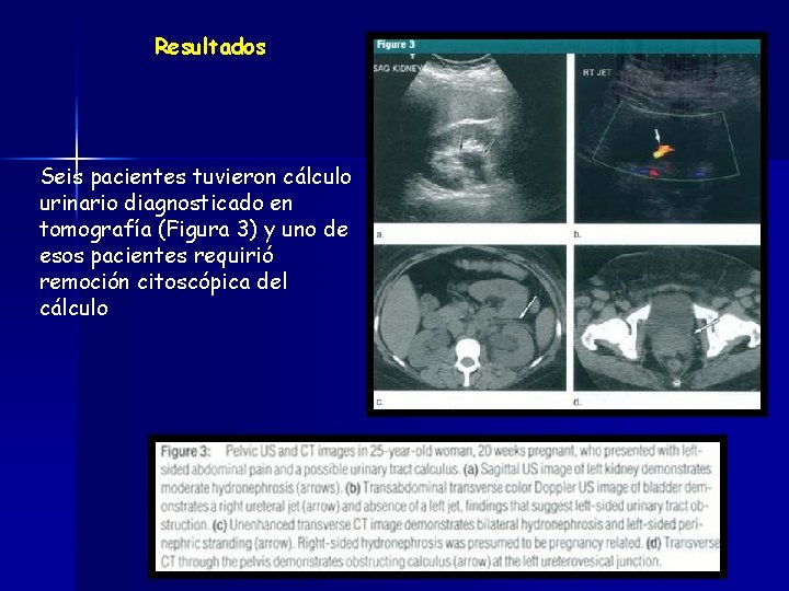 Resultados Seis pacientes tuvieron cálculo urinario diagnosticado en tomografía (Figura 3) y uno de