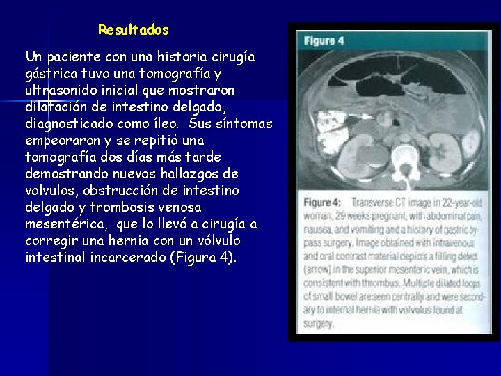 Resultados Un paciente con una historia cirugía gástrica tuvo una tomografía y ultrasonido inicial