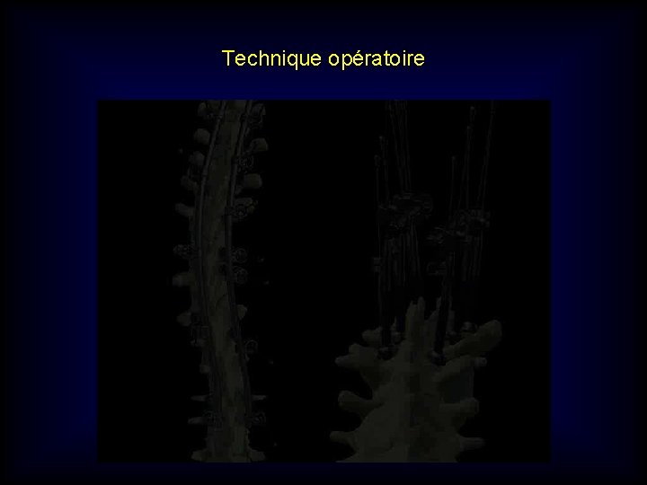 Technique opératoire Technique opératoire
