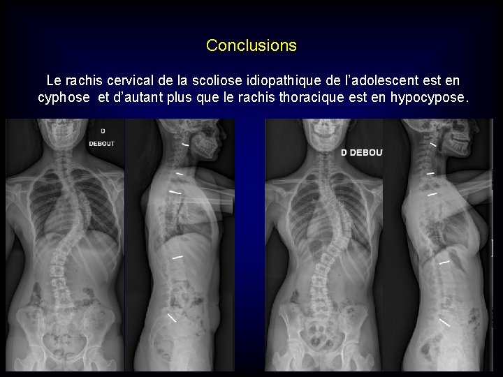 Conclusions Le rachis cervical de la scoliose idiopathique de l’adolescent est en cyphose et Conclusions Le rachis cervical de la scoliose idiopathique de l’adolescent est en cyphose et