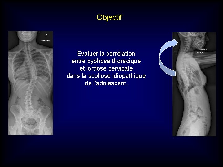 Objectif Evaluer la corrélation entre cyphose thoracique et lordose cervicale dans la scoliose idiopathique Objectif Evaluer la corrélation entre cyphose thoracique et lordose cervicale dans la scoliose idiopathique