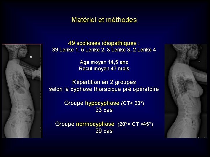 Matériel et méthodes 49 scolioses idiopathiques : 39 Lenke 1, 5 Lenke 2, 3 Matériel et méthodes 49 scolioses idiopathiques : 39 Lenke 1, 5 Lenke 2, 3