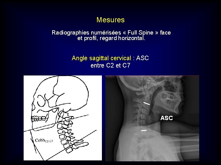 Mesures Radiographies numérisées « Full Spine » face et profil, regard horizontal. Angle sagittal Mesures Radiographies numérisées « Full Spine » face et profil, regard horizontal. Angle sagittal