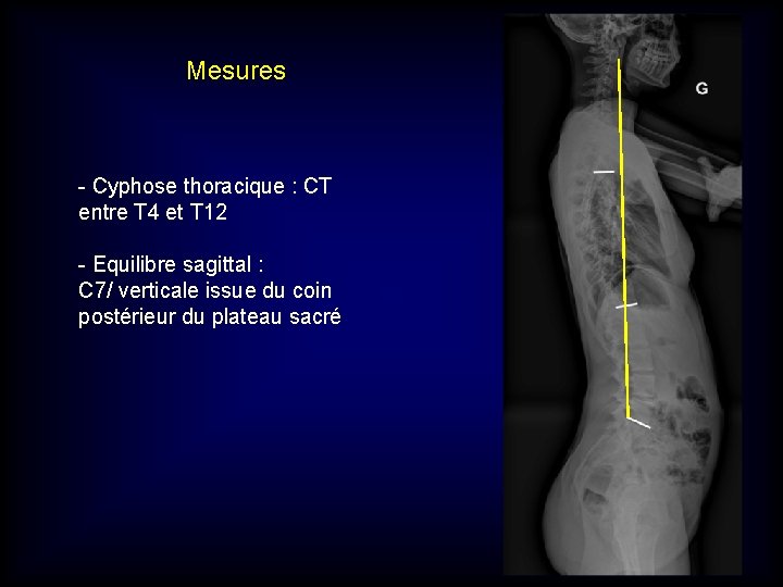 Mesures - Cyphose thoracique : CT entre T 4 et T 12 - Equilibre Mesures - Cyphose thoracique : CT entre T 4 et T 12 - Equilibre