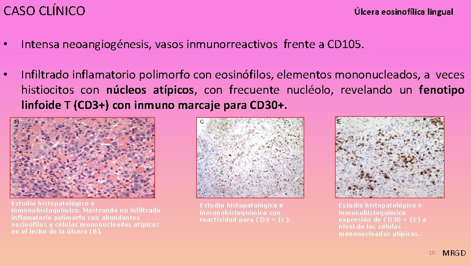 CASO CLÍNICO Úlcera eosinofílica lingual • Intensa neoangiogénesis, vasos inmunorreactivos frente a CD 105.