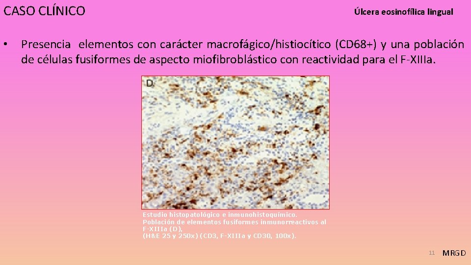 CASO CLÍNICO • Úlcera eosinofílica lingual Presencia elementos con carácter macrofágico/histiocítico (CD 68+) y