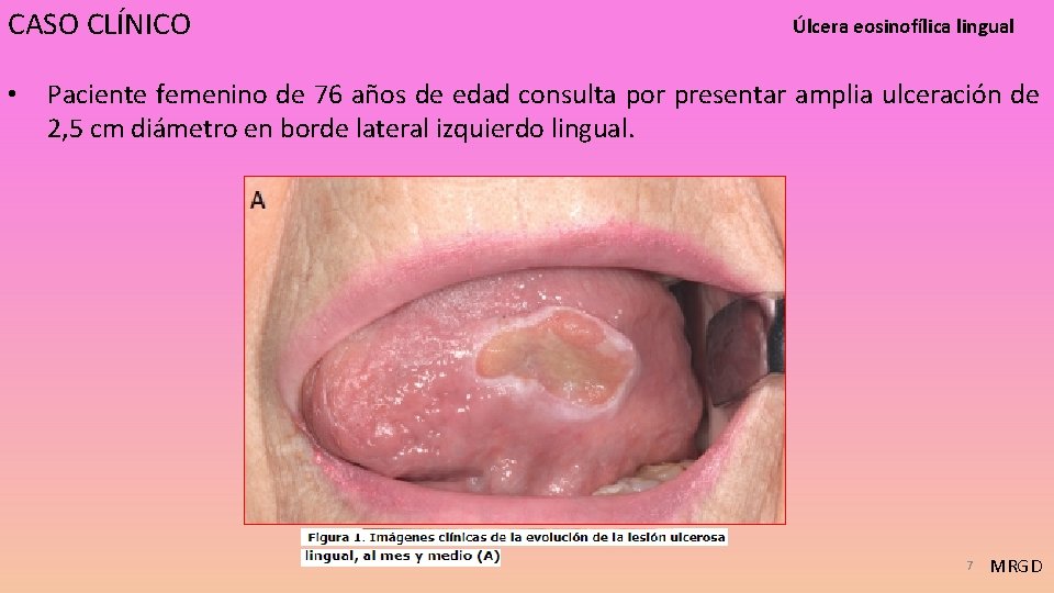 CASO CLÍNICO • Úlcera eosinofílica lingual Paciente femenino de 76 años de edad consulta