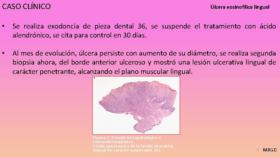 CASO CLÍNICO Úlcera eosinofílica lingual • Se realiza exodoncia de pieza dental 36, se