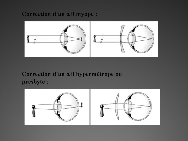 Correction d'un œil myope : Correction d'un œil hypermétrope ou presbyte : 