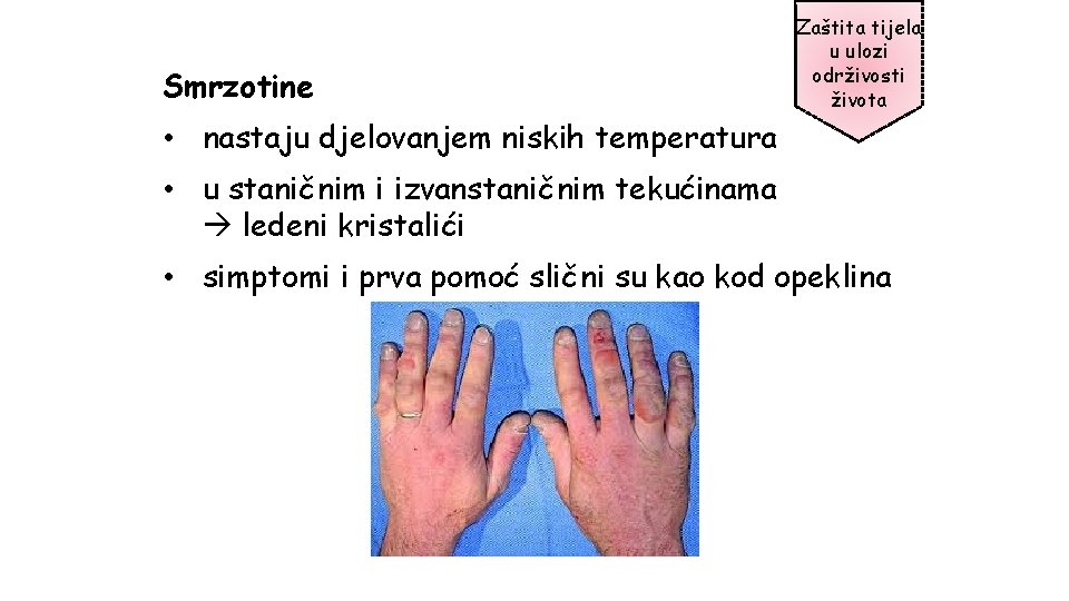 Smrzotine Zaštita tijela u ulozi održivosti života • nastaju djelovanjem niskih temperatura • u