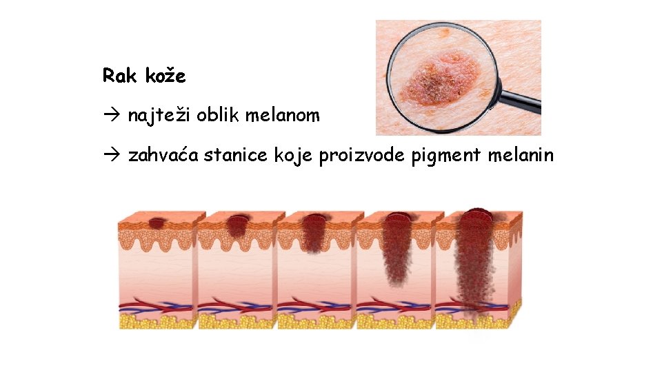 Rak kože najteži oblik melanom zahvaća stanice koje proizvode pigment melanin 