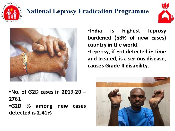 National Leprosy Eradication Programme • India is highest leprosy burdened (58% of new cases)