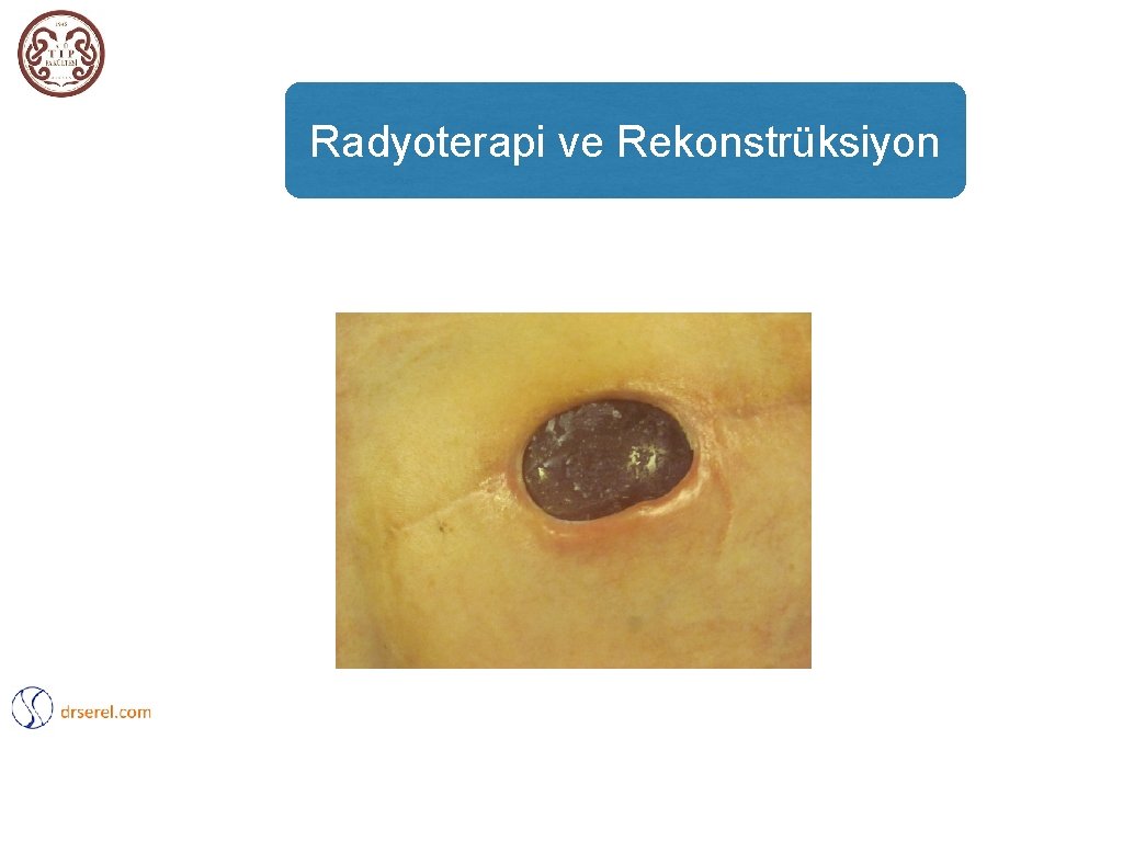 Radyoterapi ve Rekonstrüksiyon 