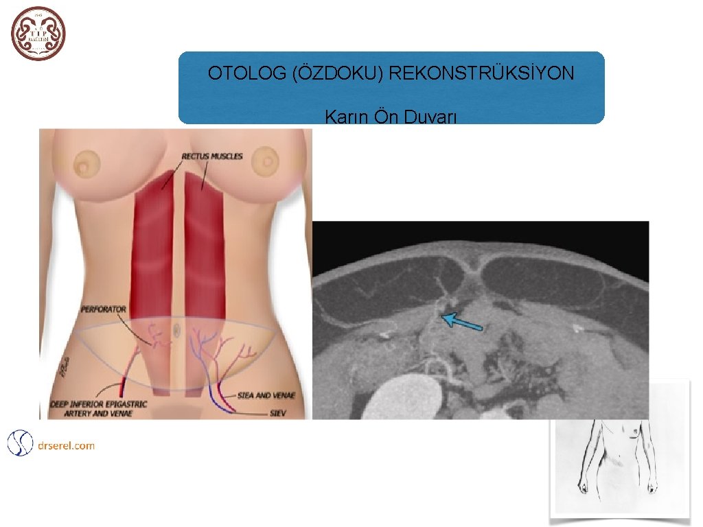 OTOLOG (ÖZDOKU) REKONSTRÜKSİYON Karın Ön Duvarı 