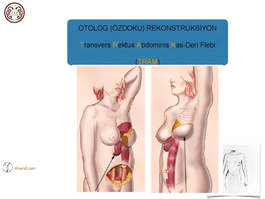 OTOLOG (ÖZDOKU) REKONSTRÜKSİYON Transvers Rektus Abdominis Kas-Deri Flebi (TRAM) 