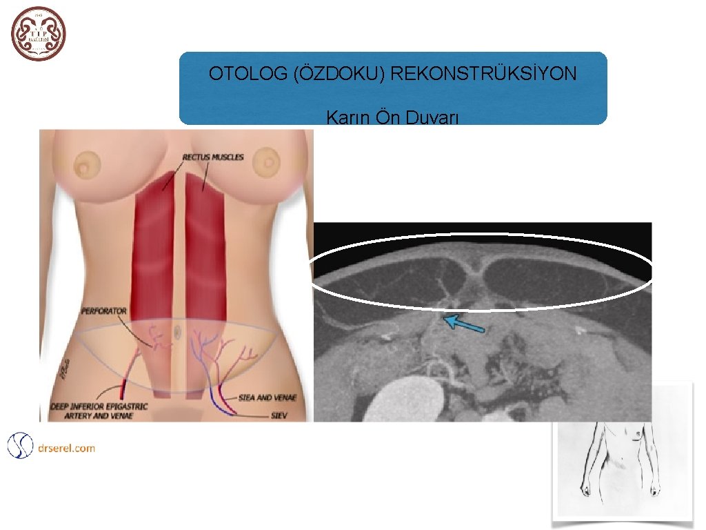 OTOLOG (ÖZDOKU) REKONSTRÜKSİYON Karın Ön Duvarı 